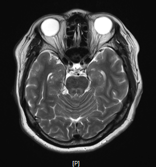 [현직자 건강] "몸이 가라앉는 느낌..." 이유 없는 두통과 오심, 뇌 MRI 검사대에 누워 깨달은 ....