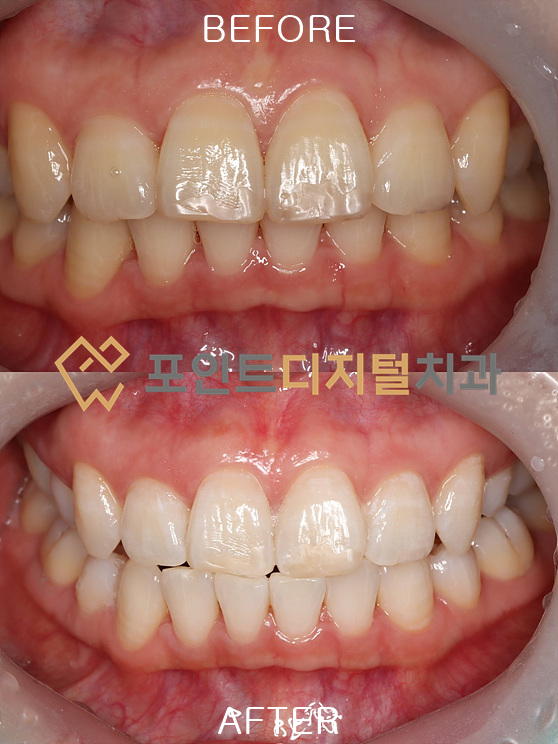 [쌍용 치아미백] 누런 이 고민 끝! 40대 여성분의 치아미백 폭발코스(A4→B2) 리얼 후기 / 천안 아산