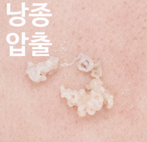 사타구니 종기 계속 생기는데 단순 모낭염이 아닐 수 있습니다.