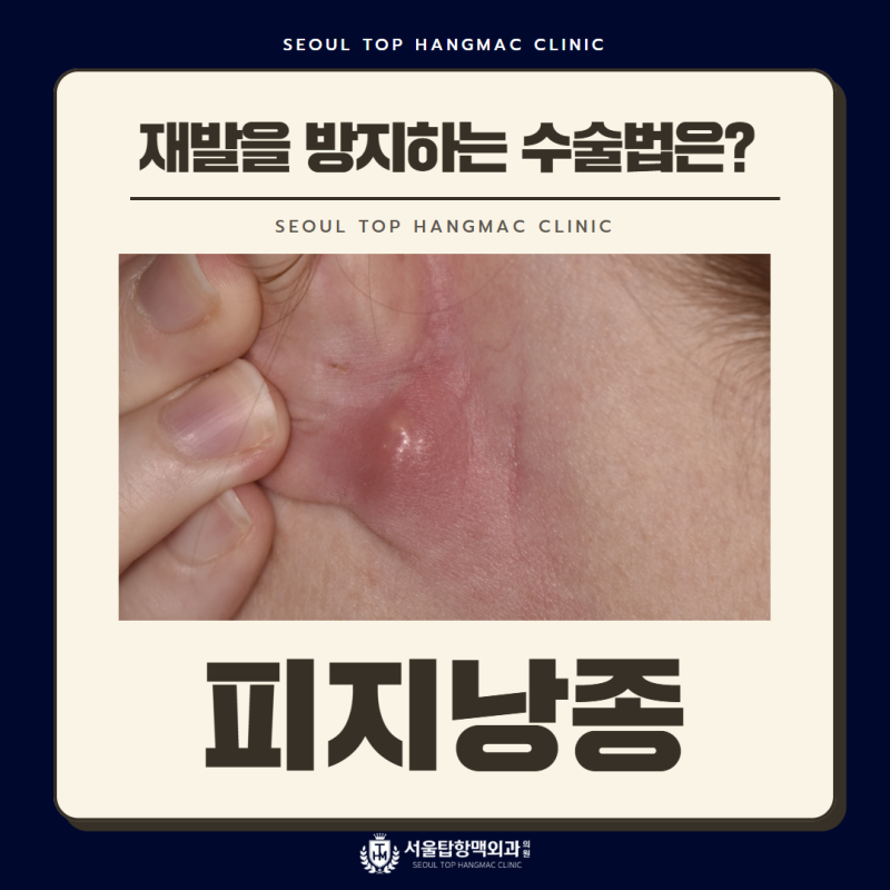 부산피지낭종 재발을 방지할 수 있는 수술법은?