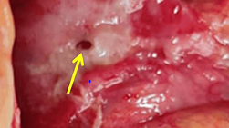 29. 위궤양 천공에서 시행하는 stomach anterior wall primary repair 간호 위궤양천공 복강경수술, 위궤....