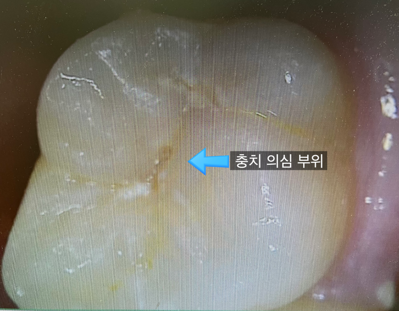 어금니 레진 떨어짐, 깊은 충치도 쉽게 떨어지지 않게 때울 수 있다? 마포 공덕 충치 치료 후....