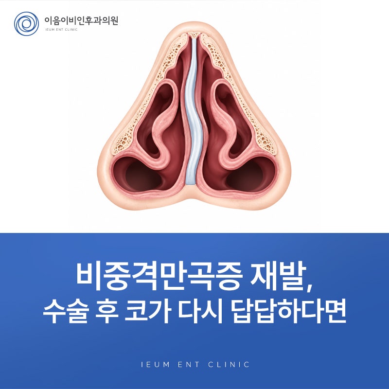 비중격만곡증 수술 후 재발했다면 확인해보세요