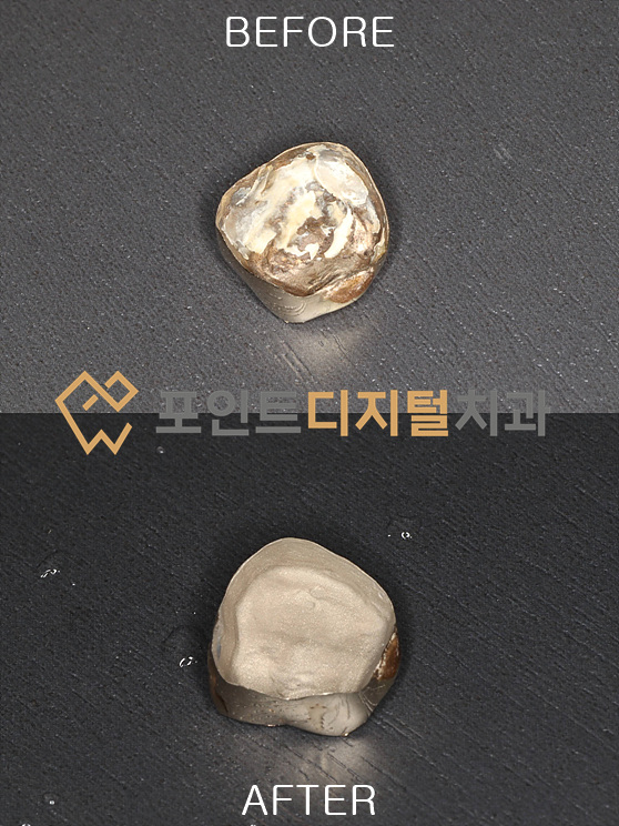 포인트디지털치과의 보철물 재부착 프로토콜 — 렌퍼트 샌드블라스트 세척 / 천안 아산 포인트디지털치과의 보철물 재부착 프로토콜 — 렌퍼트 샌드블라스트 세척 / 천안 아산