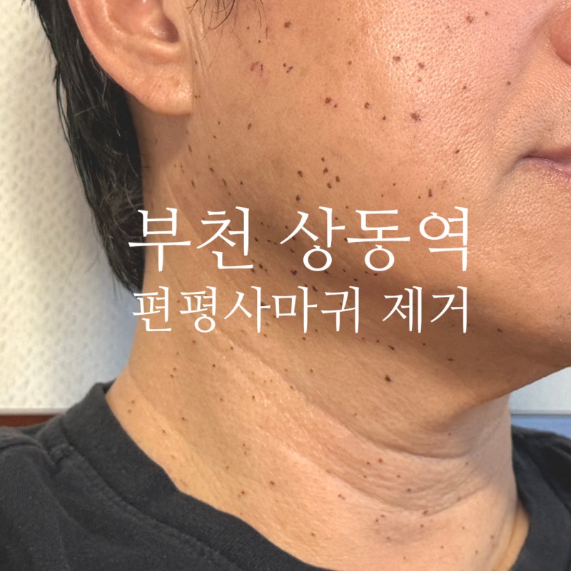 부천 상동역 편평사마귀 무제한 제거 추천