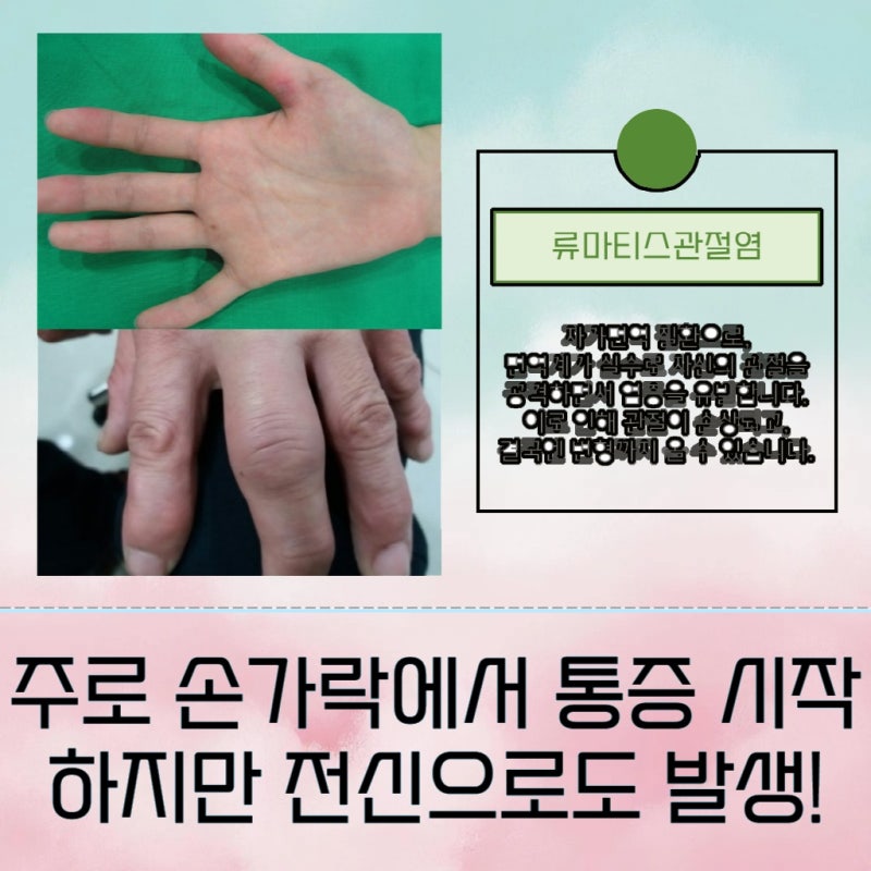 서울 성동구 류마티스 관절염 피검사 결과와 치료 계획 수립의 상관관계