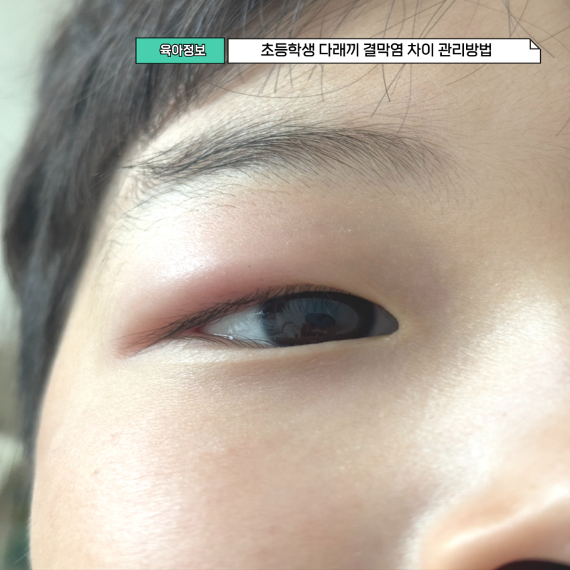 초등학생 눈다래끼 결막염 차이 관리방법