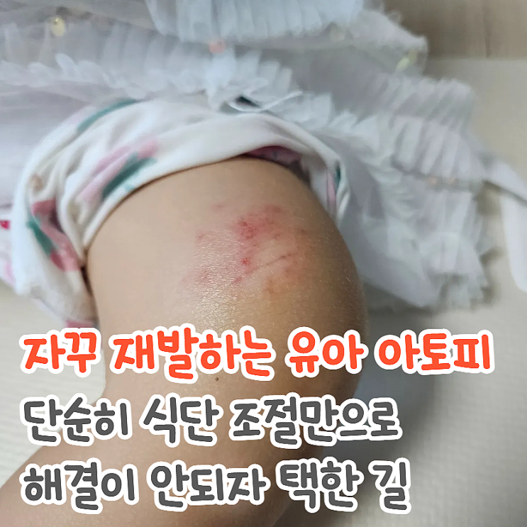 아이 아토피, 계속 반복된다면... 음식보다 먼저 확인해야 할 한 가지