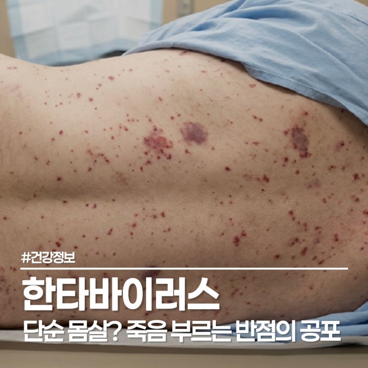  한타바이러스 감기 차이점 비교, "단순 몸살인 줄 알았는데" 붉은 반점의 정체는?