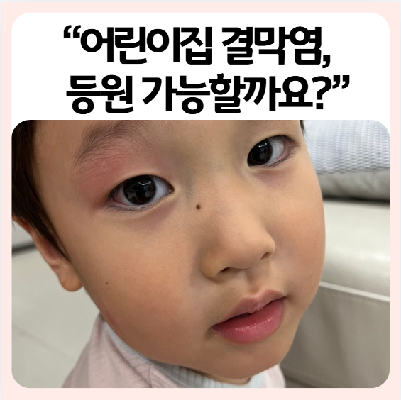 유아 결막염 원인 증상 전염 기간 어린이집 등원까지 한번에 정리했어요