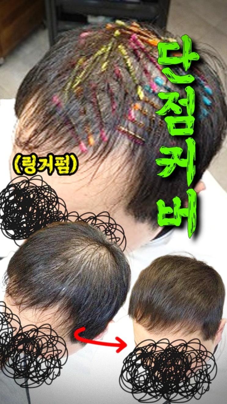  천안 불당동 정수리 링거펌 고민? 결국 수원까지 찾게 되는 이유