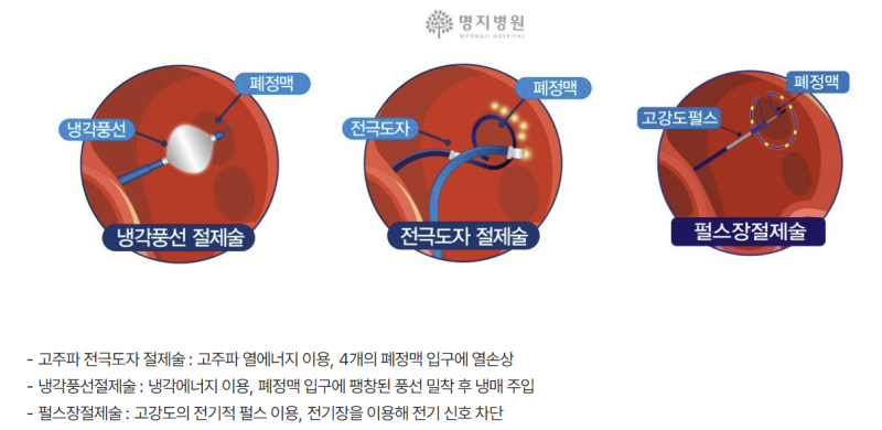 심방세동의 펄스장절제술 Pulsed Field Ablation of Atrial Fibrillation