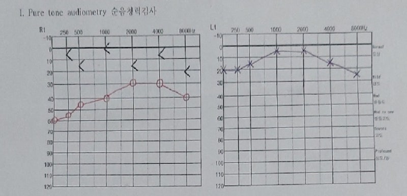 청력검사 60dB라는데 왜 평균은 22dB일까? 순음청력검사 결과 보는 법