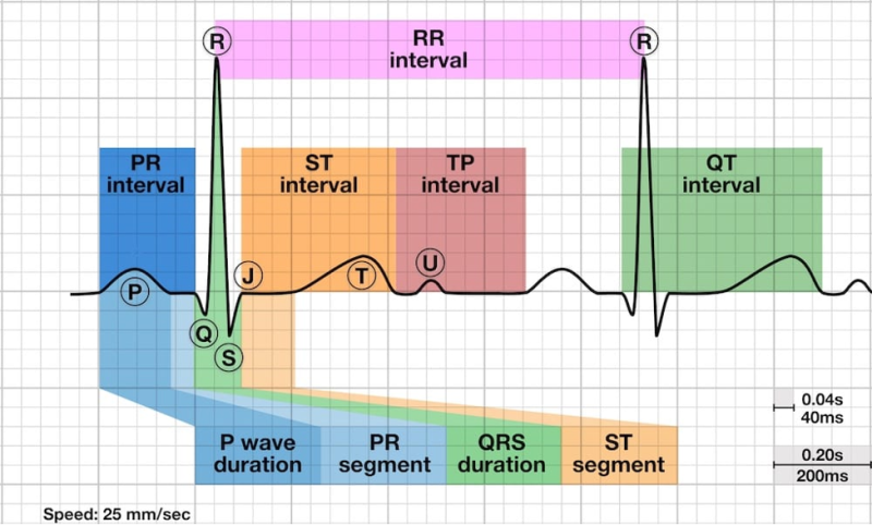 [임상 이론] 심근경색(myocardial infarction)