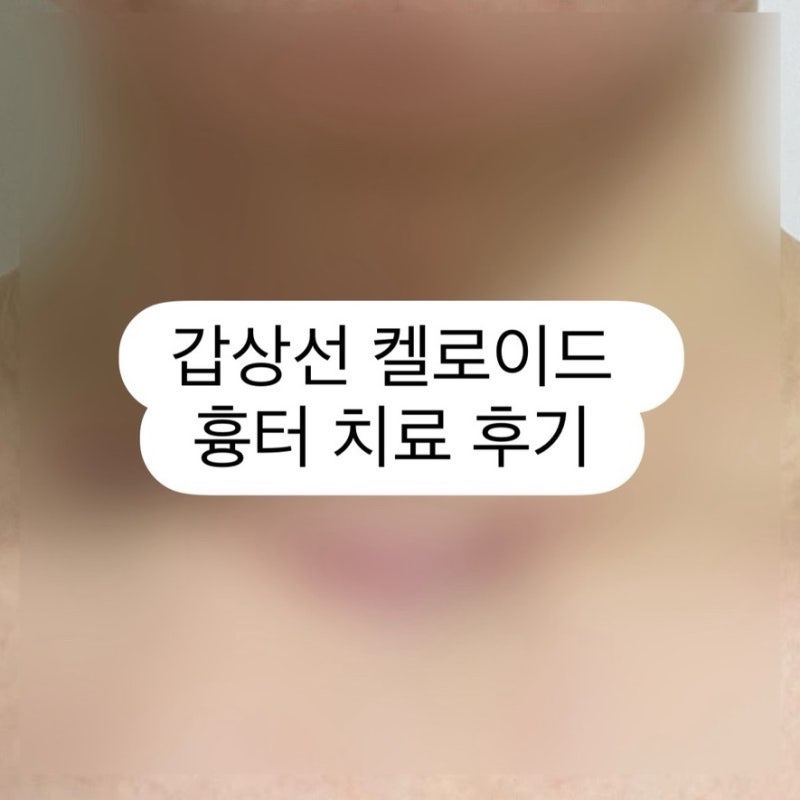 갑상선 수술 후 켈로이드(비후성 반흔) 흉터 레이저 치료 후기 (4회차)