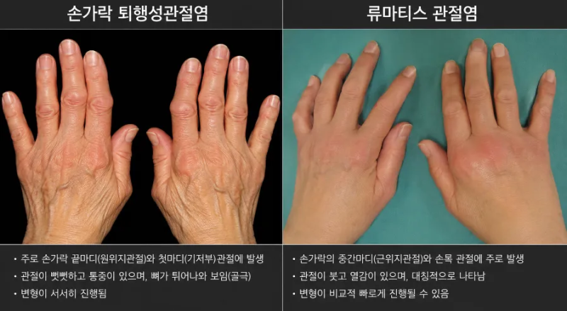 손가락 관절염에 대하여