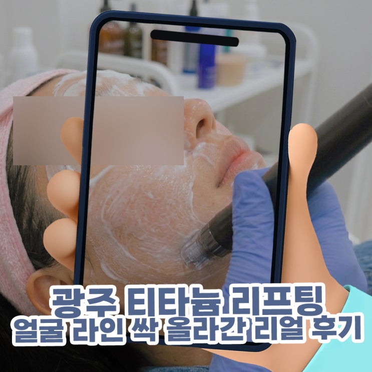  광주 티타늄 리프팅, 처진 심부볼 사라지고 얼굴 라인 싹 올라간 리얼 후기