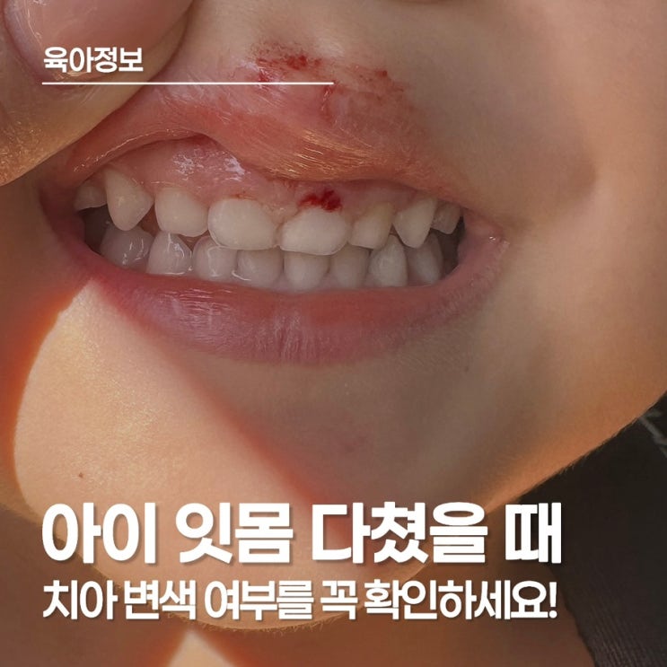  넘어져서 잇몸 피났을 때, 잇몸 찢어짐 회복 기간과 치아 변색 주의점