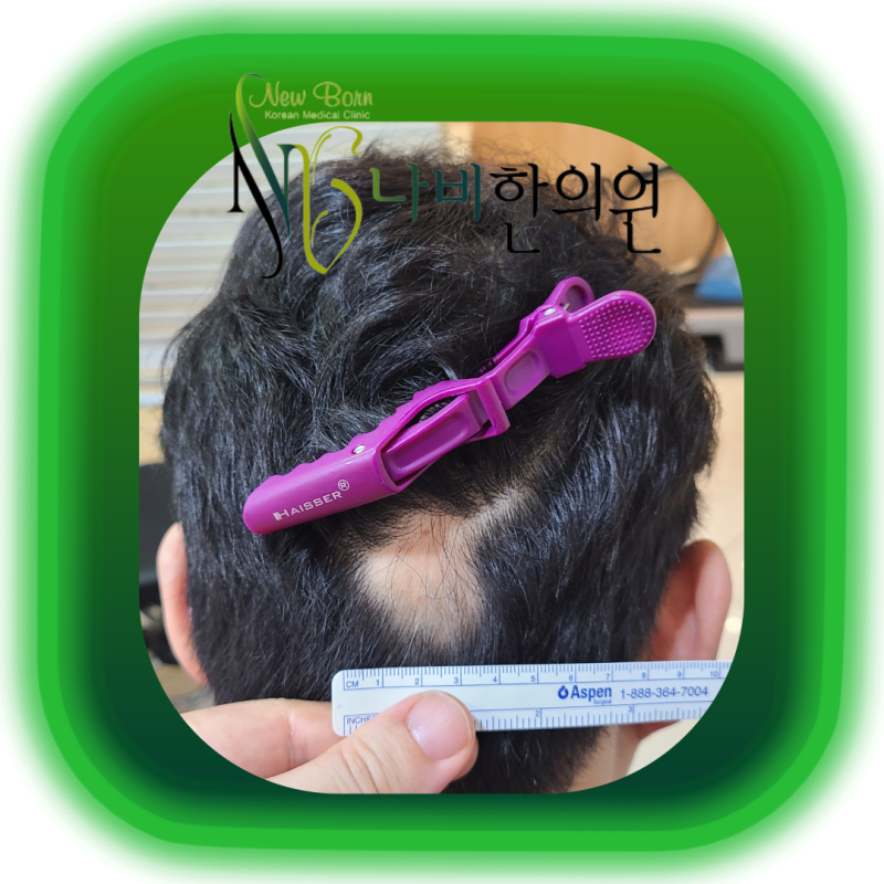 부산 원형탈모 초기, 병원 가야 할까 지켜봐도 될까 기준이 헷갈릴 때