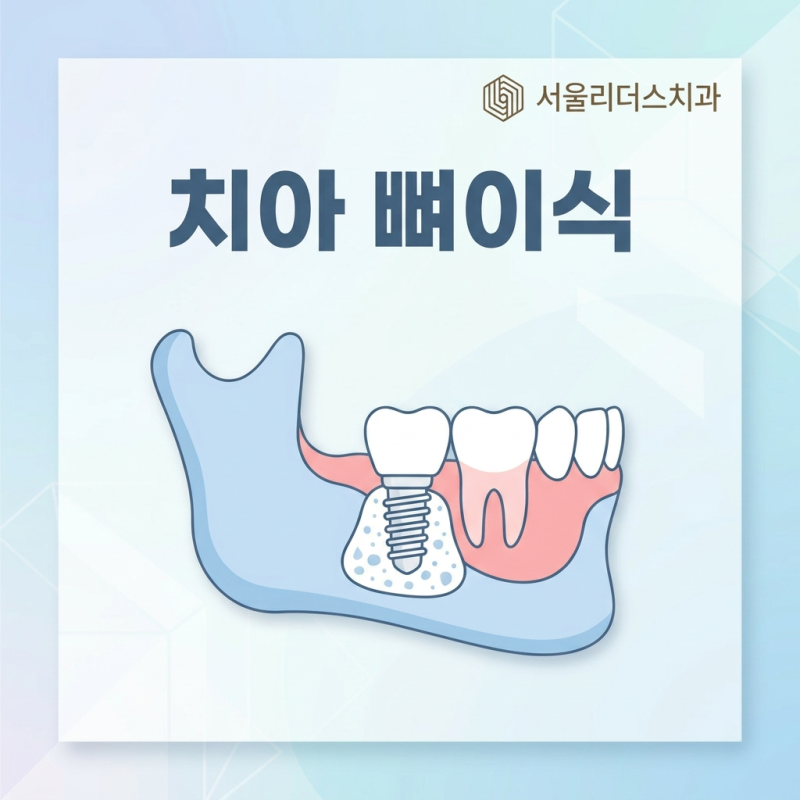 치아 뼈이식 필요한 때와 종류 정리