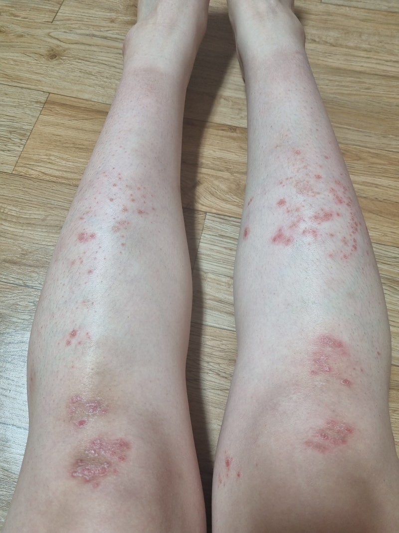 건선과 아토피 피부염의 차이점