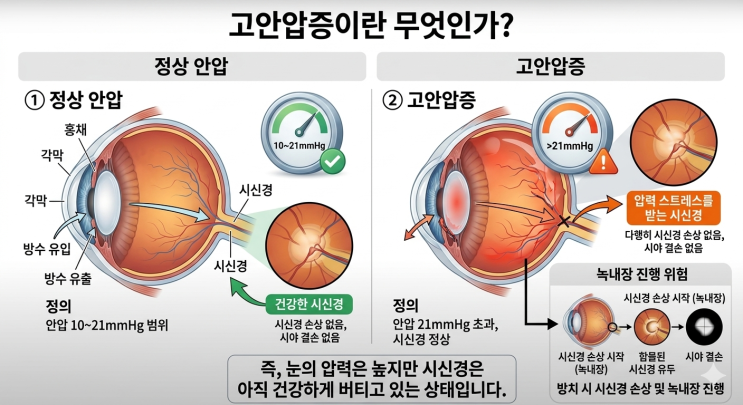  눈의 고혈압 고안압증, 방치하면 실명 위기? 6개월마다 꼭 확인해야 해야하는 이유