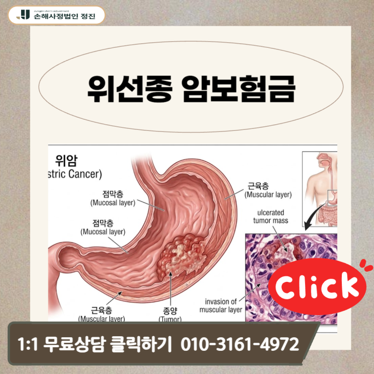  위선종 암보험금, D13.1 진단 후 보험사가 문제 삼는 포인트