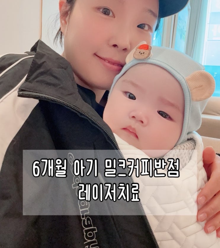  6개월 아기 밀크커피반점 레이저치료 시작 | 수원, 동탄 피부과 알아보기, 치료 1회차