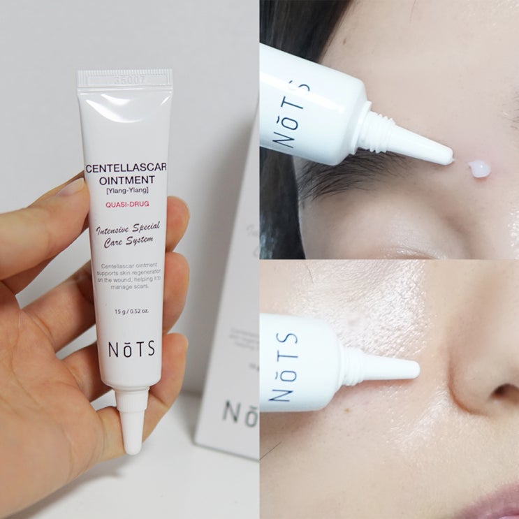  반복되는 여드름자국 색소침착 여드름흉터연고 관리 후기