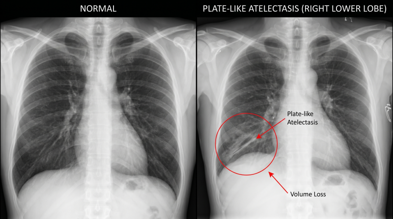 수술 후 기침 참으면 폐가 주저앉는다? 폐허탈(Atelectasis) 예방을 위한 강화폐활량계(Incentive Sp....