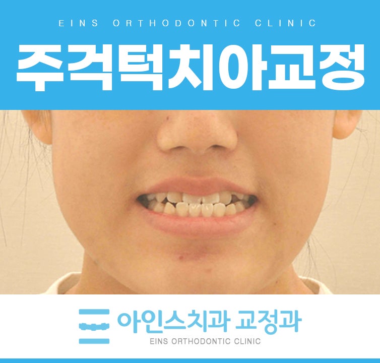 주걱턱치아교정 전후 교합까지 완성되어야 성공적
