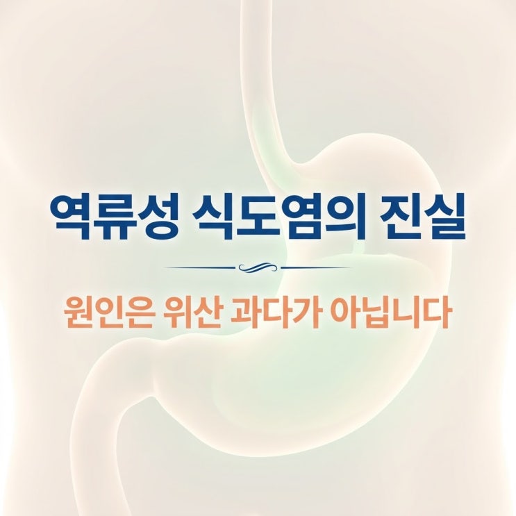  역류성 식도염 원인 증상, 넥시움 겔포스 개비스콘 한계와 반하사심탕 한의원 치료