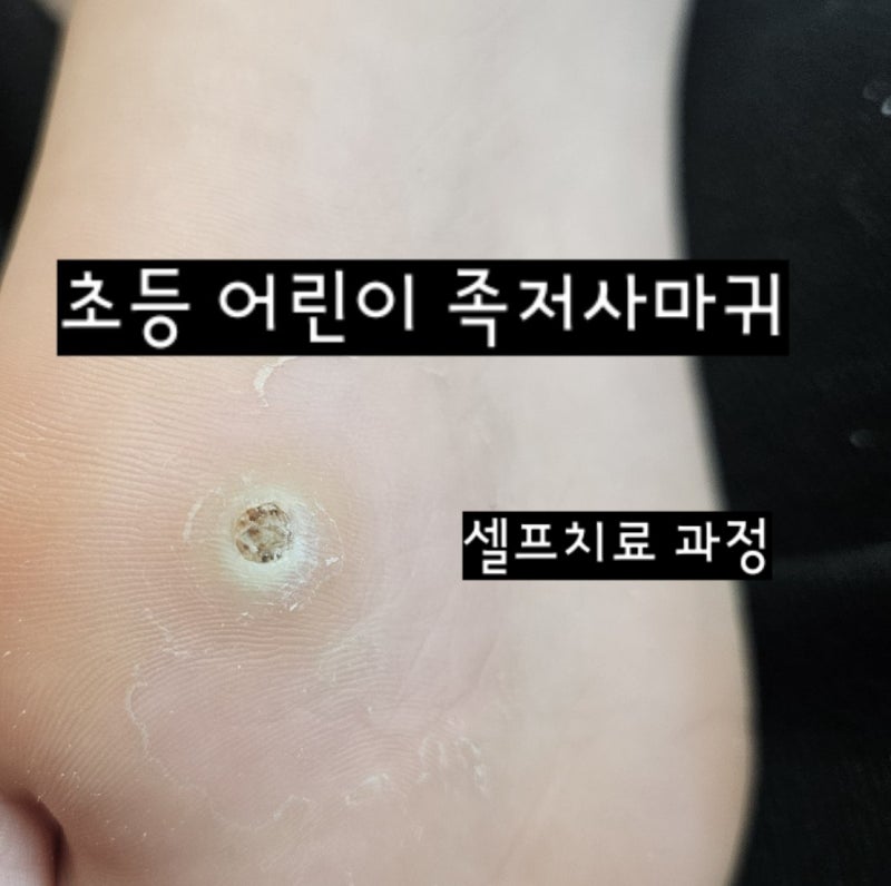 초등 어린이 족저사마귀 병원 대신 약국약으로 셀프 치료 경과 찐 후기 (티눈액 vs 콜로덤에....