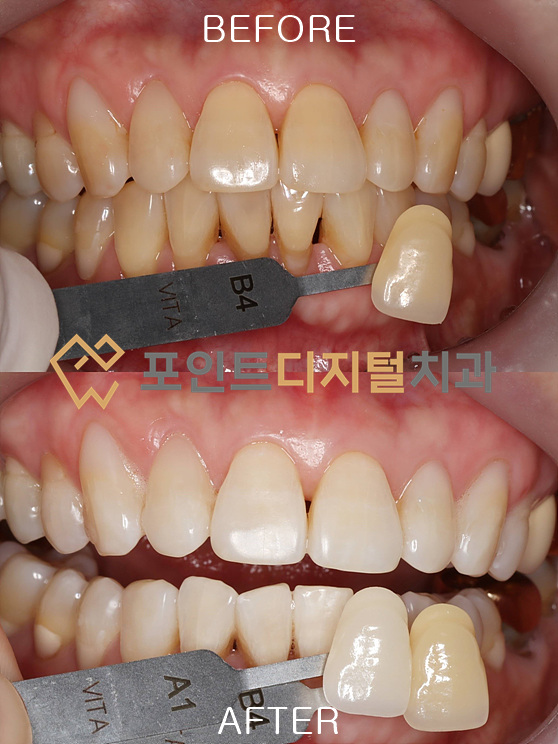 [신창 치아미백] 60대에도 반짝이는 미소를! 나이를 잊게 하는 미백폭발코스 전후 비교 / 천안 아산