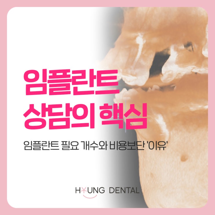  곡선동 치과가 말하는 임플란트 상담의 핵심