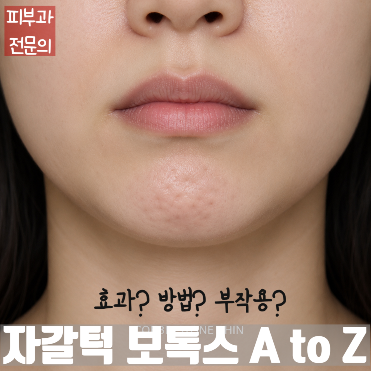  자갈턱보톡스의 모든 것! 최신논문에 기반한 효과, 방법, 부작용 (무턱과 자갈턱이 함께 있다면?)