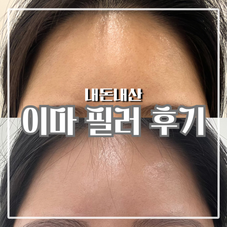  이마 필러 후기 추가 3cc 내돈내산 후기 15일차 변화 기록
