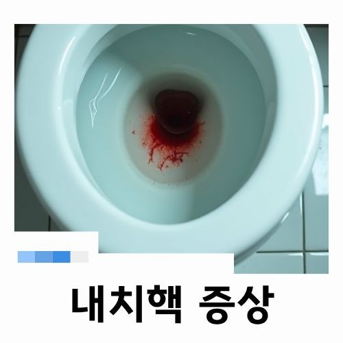 대변볼때피 난다면 내치핵 증상 치핵 자연치료