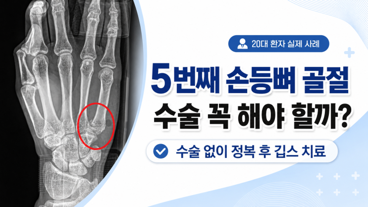  20대 남성의 5번째 손등뼈 골절, 수술 없이 치료를 시작한 이야기  (정형외과의사작성)