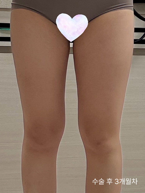  허벅지지방흡입비용 고민, 실패 없는 선택 기준은?
