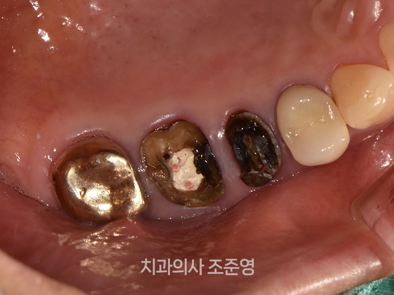 크라운 수명과 교체 시기, 구로동 임플란트를 고려해야 하는 경우에 대해