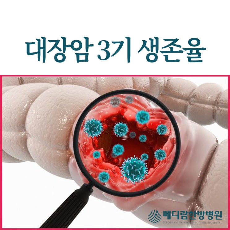 <b>대장암</b> 3기 생존율, 수술 후 관리 총망라