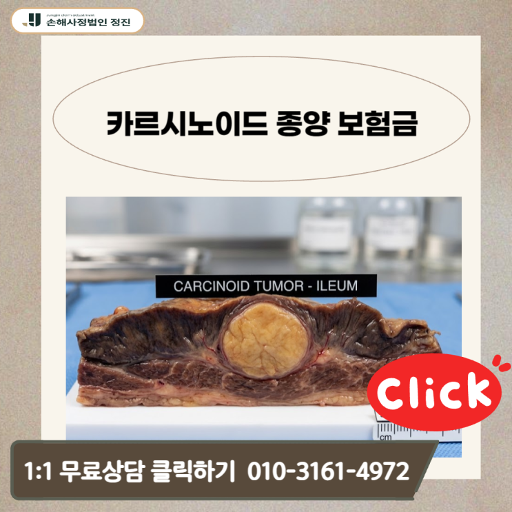  카르시노이드 종양 보험금, 삭감 통보를 전액 지급으로 돌려놓는 비법공개