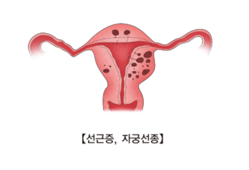 자궁선근증 자궁적출수술 후기, 3년 지난 지금 느끼는 변화