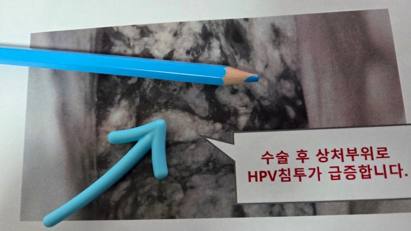 원추절제술 후 출혈 관리는 어떻게 해야할까