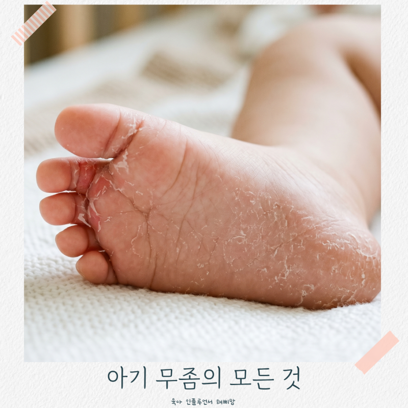 아기 무좀 어린이 엄지 발톱 발바닥 원인 증상 치료 약까지