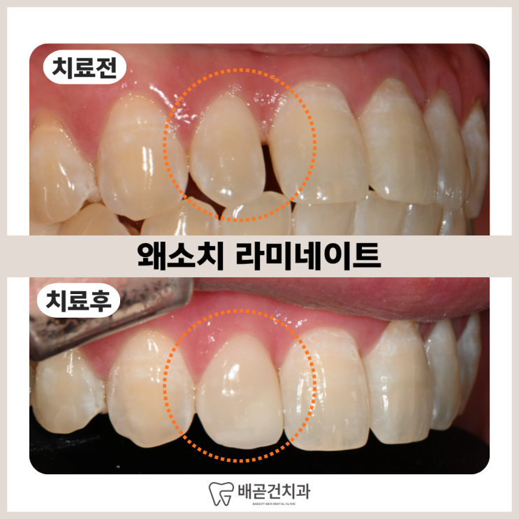  왜소치 라미네이트, 작은 앞니 하나만 해도 괜찮을까요? (실제 케이스)