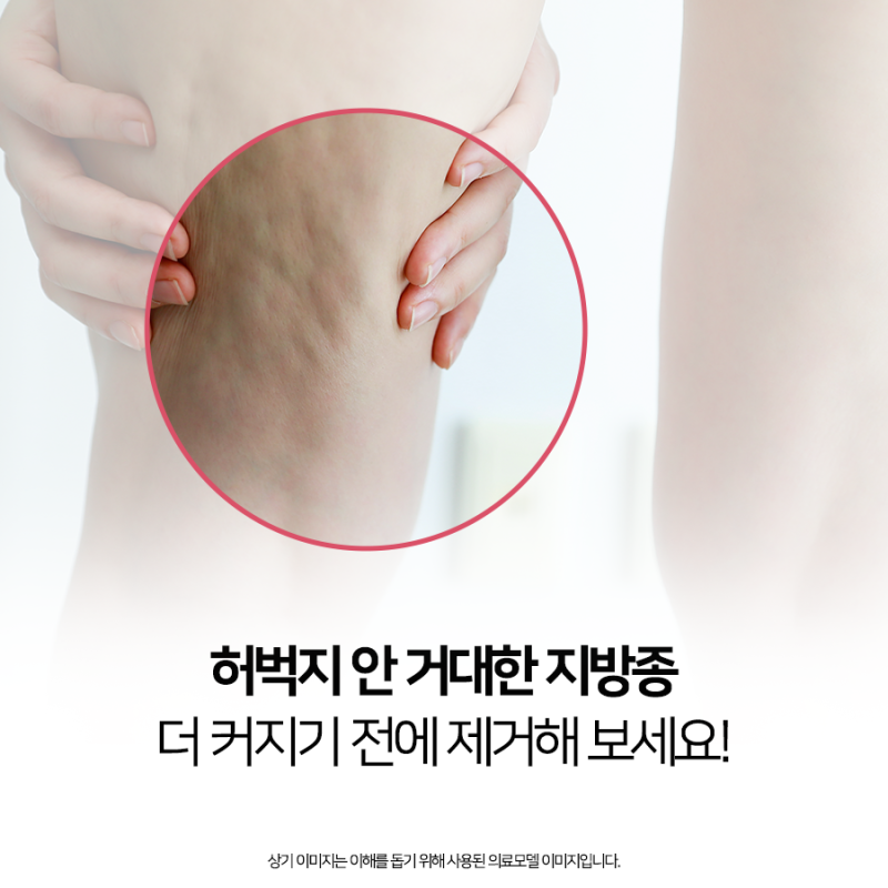 부산허벅지거대지방종제거, 수술을 통해서 제거하셔야 합니다.
