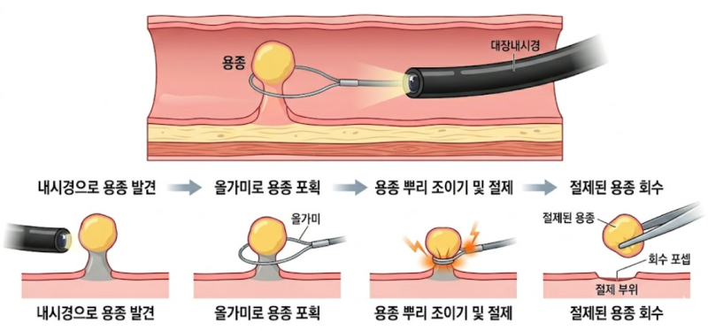 왜 대장내시경 용종 절제술은 수술에 포함되는걸까
