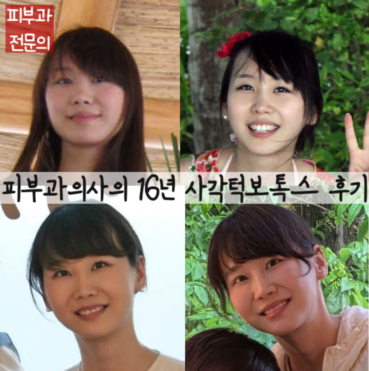  피부과의사가 16년간 받은 사각턱보톡스 후기. 효과, 방법, 부작용, 추천하지 않는 경우